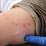 First death from measles confirmed in CDMX; There are 184 cases between 2025 and 2026 in the capital