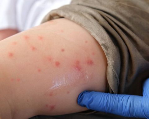 First death from measles confirmed in CDMX; There are 184 cases between 2025 and 2026 in the capital
