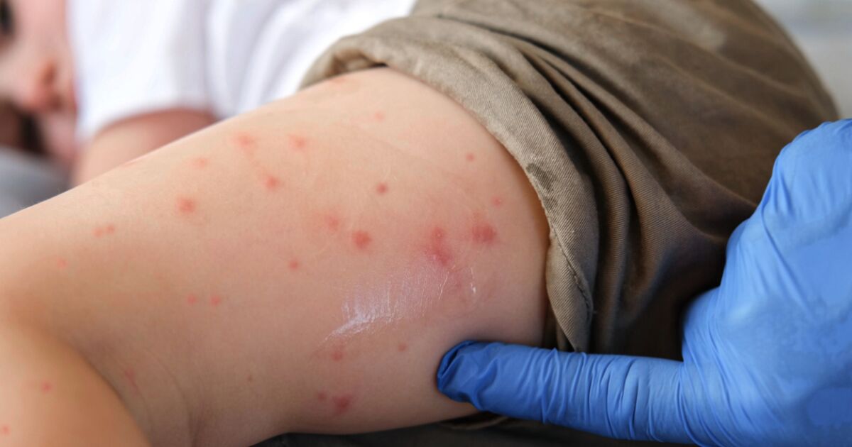 First death from measles confirmed in CDMX; There are 184 cases between 2025 and 2026 in the capital